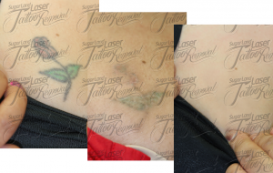 Laser Tattoo Removal Before and After 