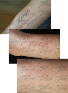 houston tattoo removal pics