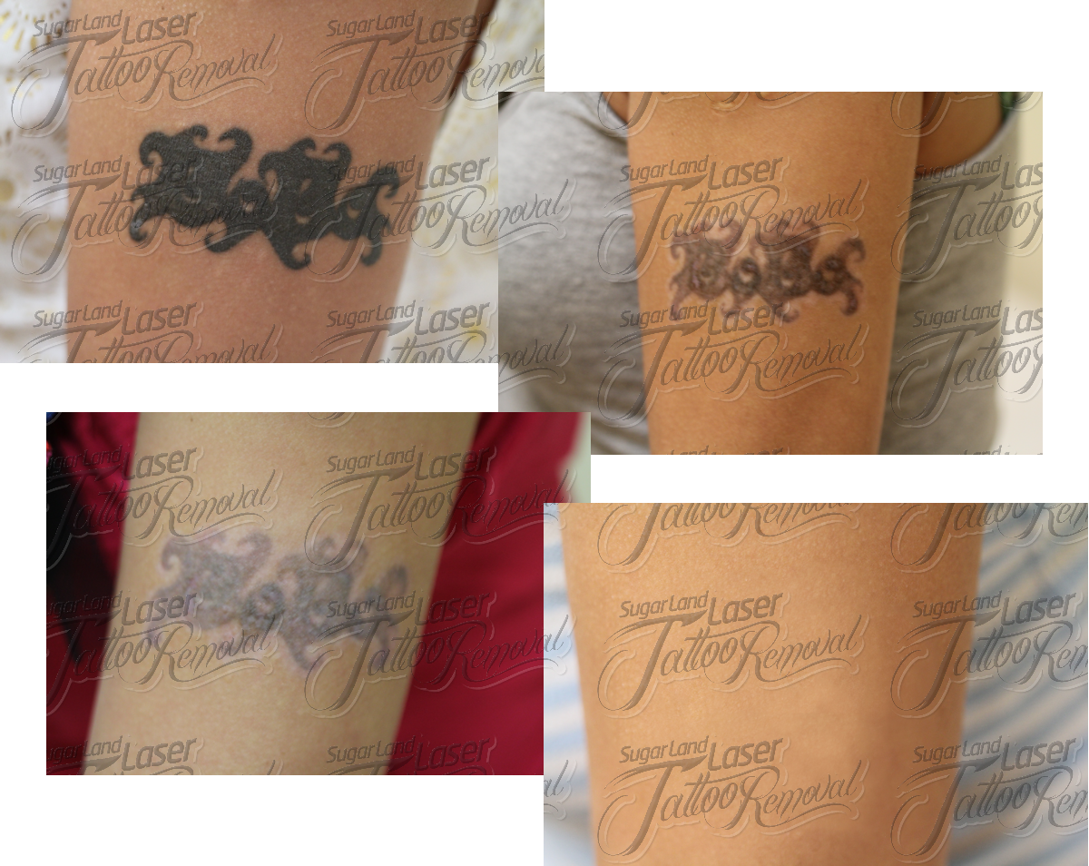 Laser Tattoo Removal Houston Before and After Pictures-Sugar Land