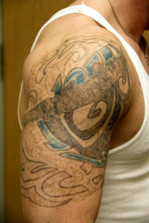 Tattoo Removal Service in Seattle  Seattle Tattoo Removal