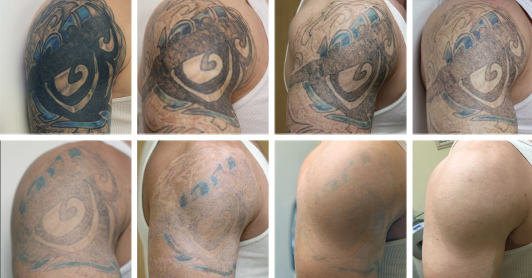 Laser Tattoo Removal Houston