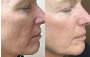 prp acne scar removal